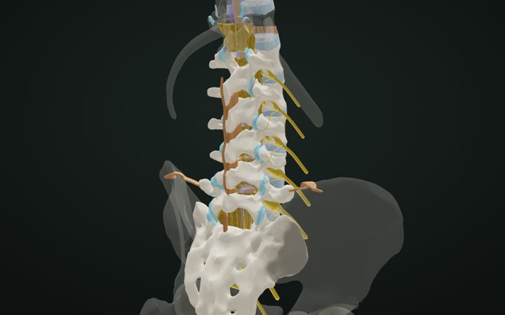 3D model of the lumbosacral spine with discs, dural sac and nerve roots